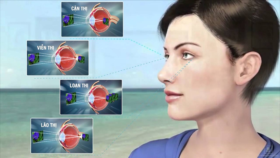 Cận thị là một trong những tật khúc xạ phổ biến nhất